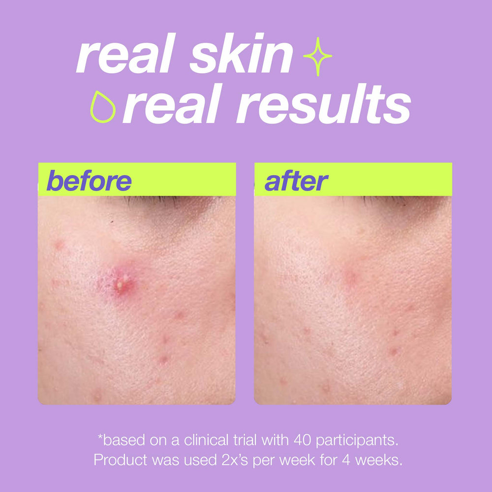 Before and after comparison of skin treatment on a purple background with text about clinical trial results.