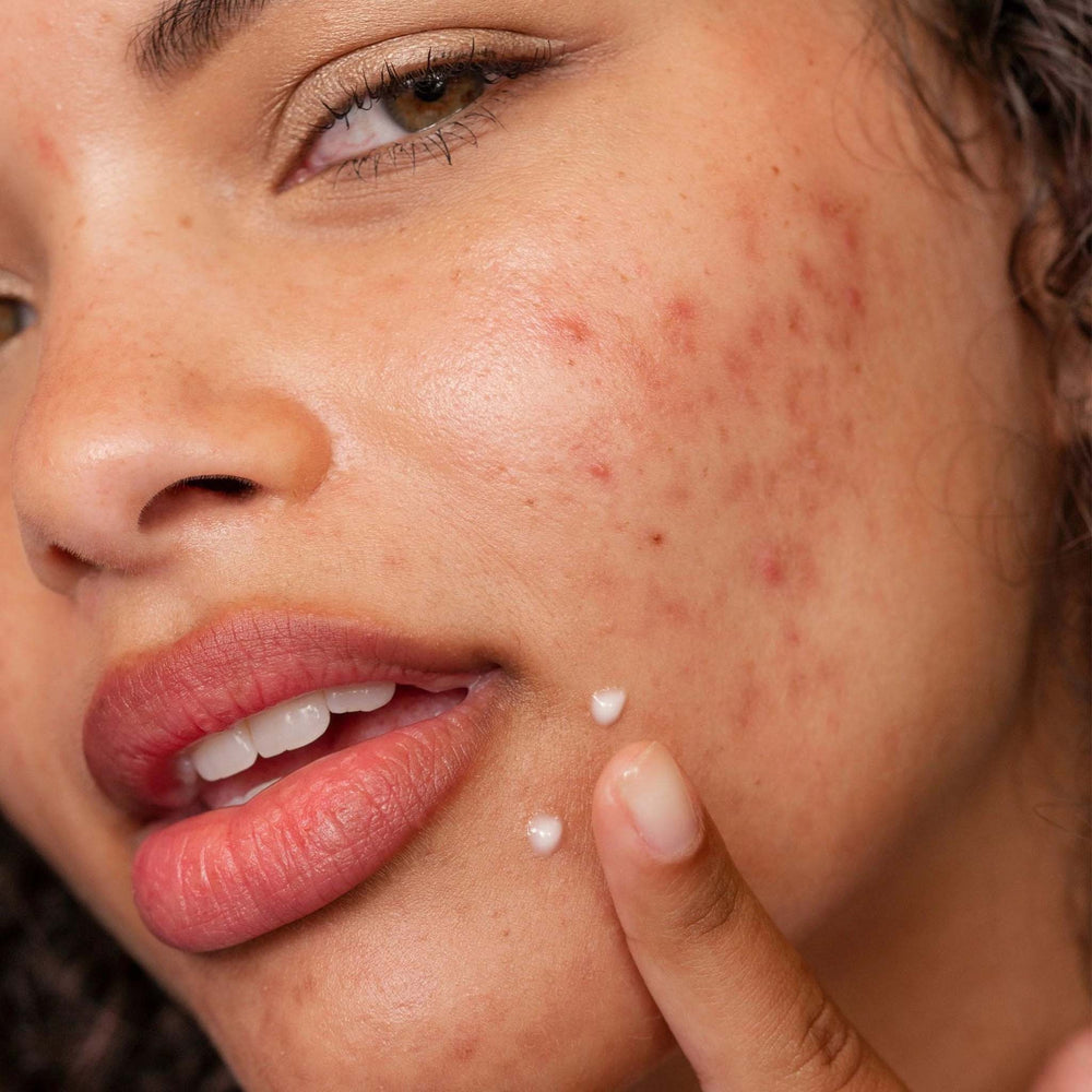 Close-up of a person applying post-breakout fix cream to their face with visible acne.