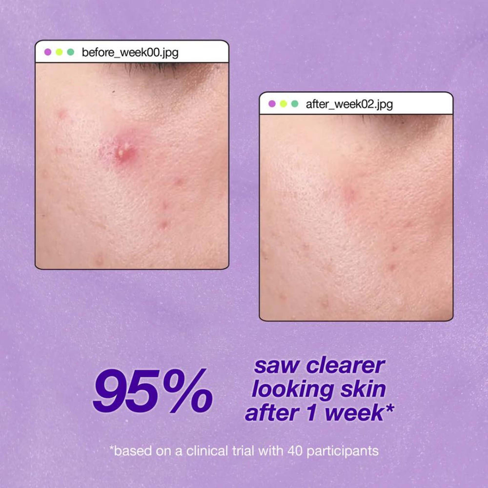 Before and after comparison of skin with acne treatment showing 95% improvement after one week on a purple background.