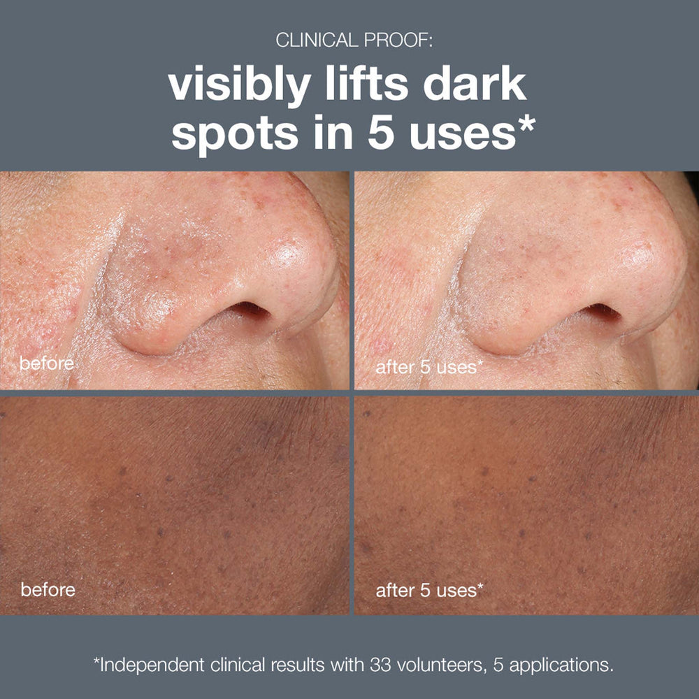 Before and after skin treatment results showing dark spots reduction on a person's nose.