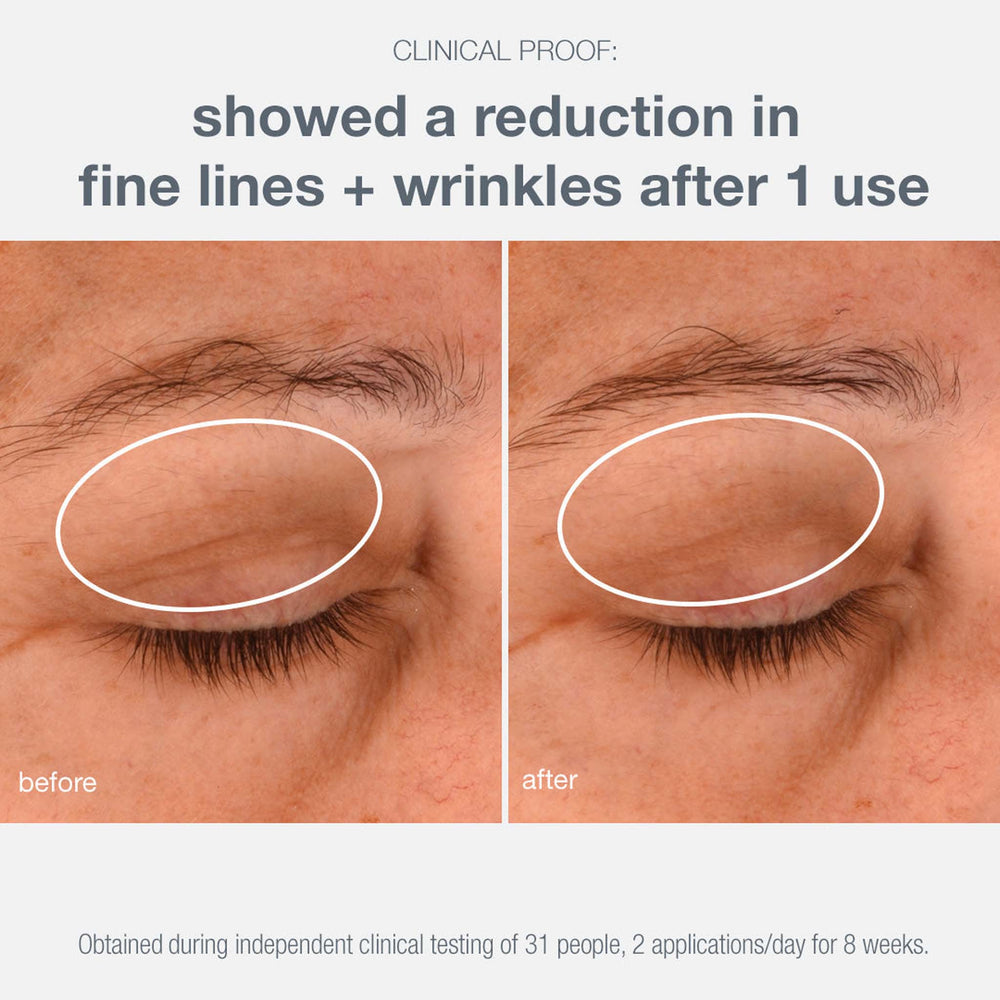 Before and after comparison of eye area with text indicating reduction in fine lines and wrinkles.