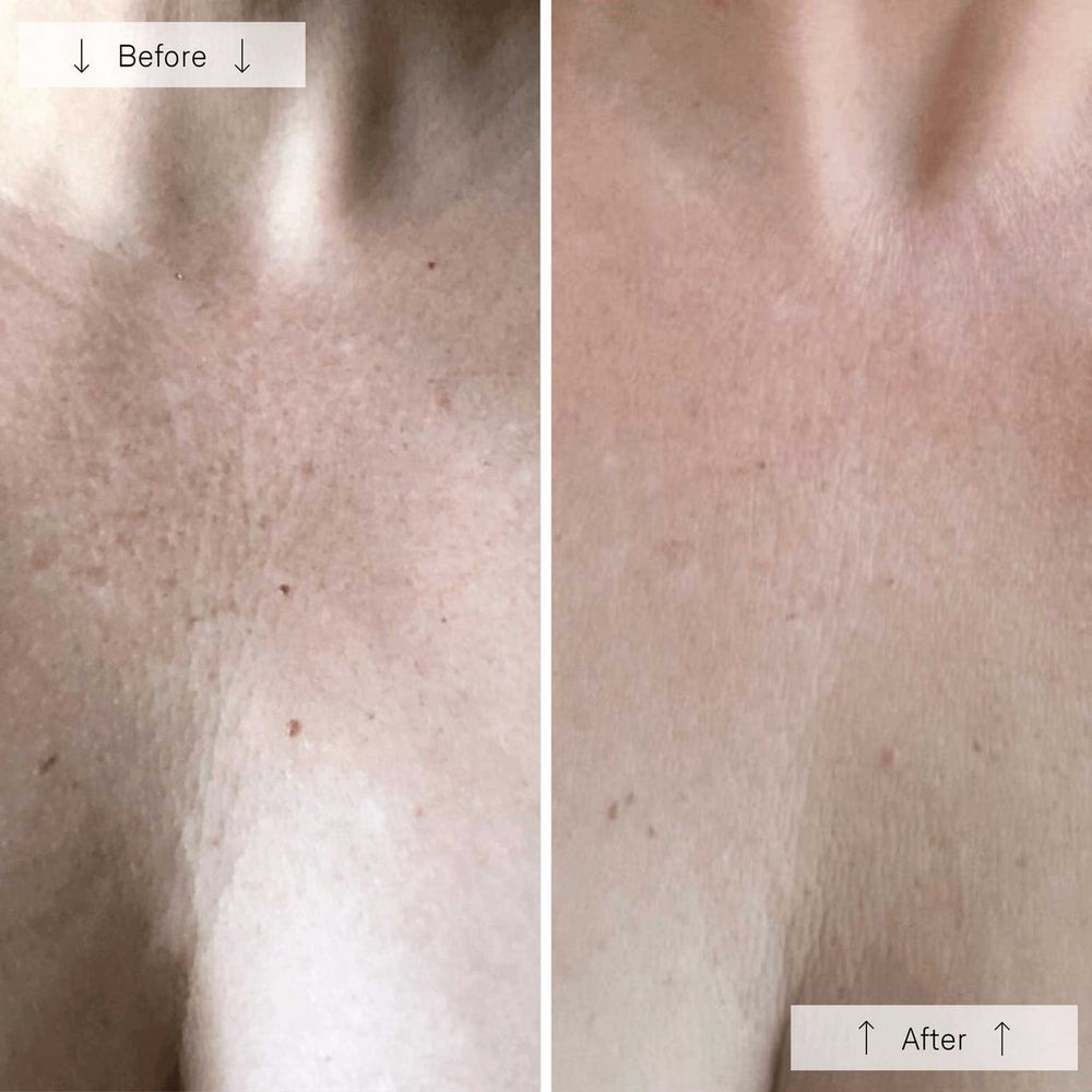 Omnilux Contour Neck Decollete L.E.D. The Facial Maestro before and after comparison of skin texture on a person's shoulder.