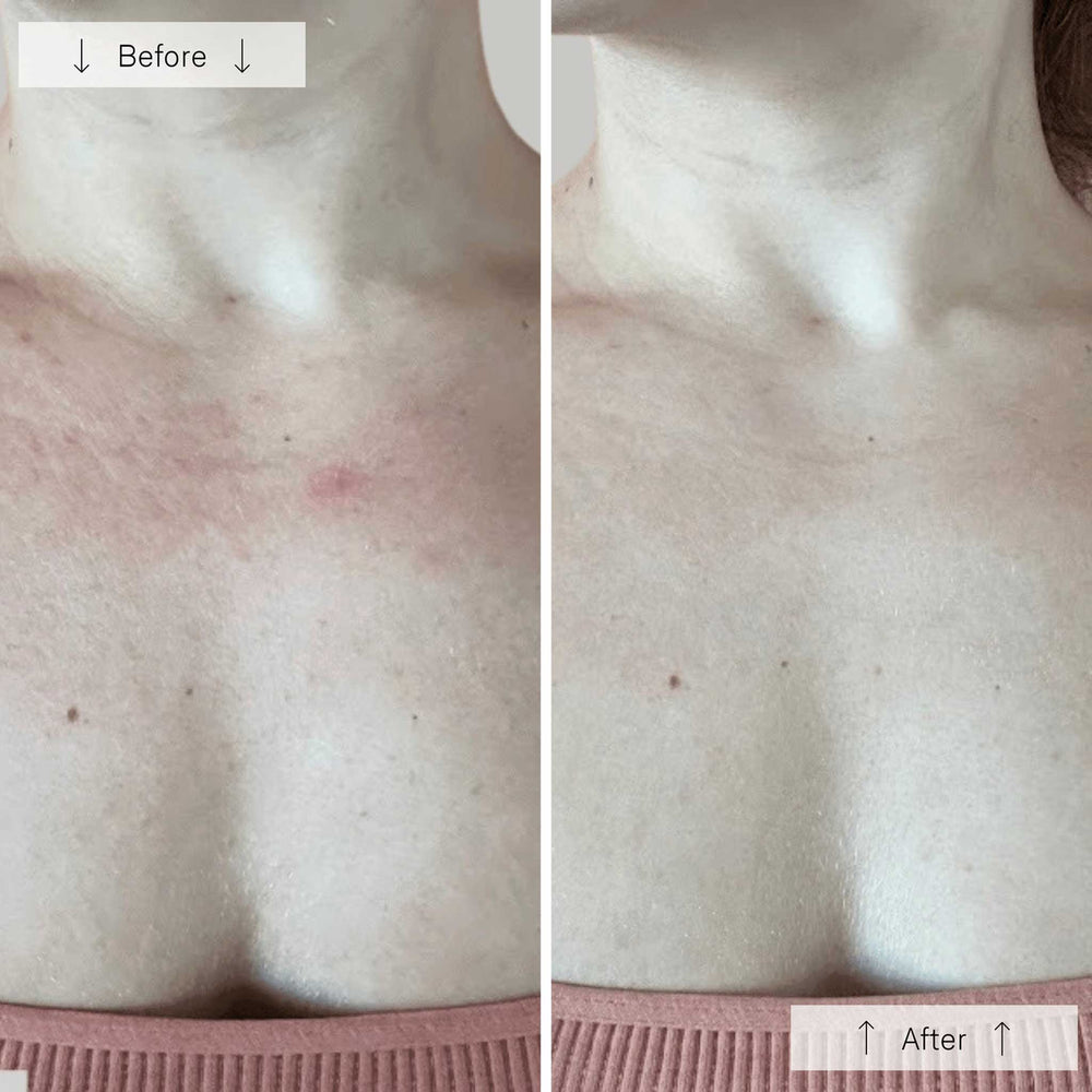 Omnilux Contour Neck Decollete L.E.D. The Facial Maestro before and after comparison of skin texture on a person's chest area.
